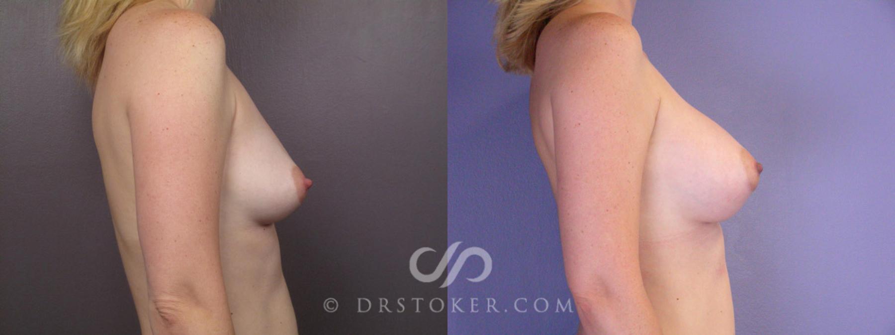 Before & After Breast Augmentation, Rapid Recovery Case 194 View #4 View in Los Angeles, CA