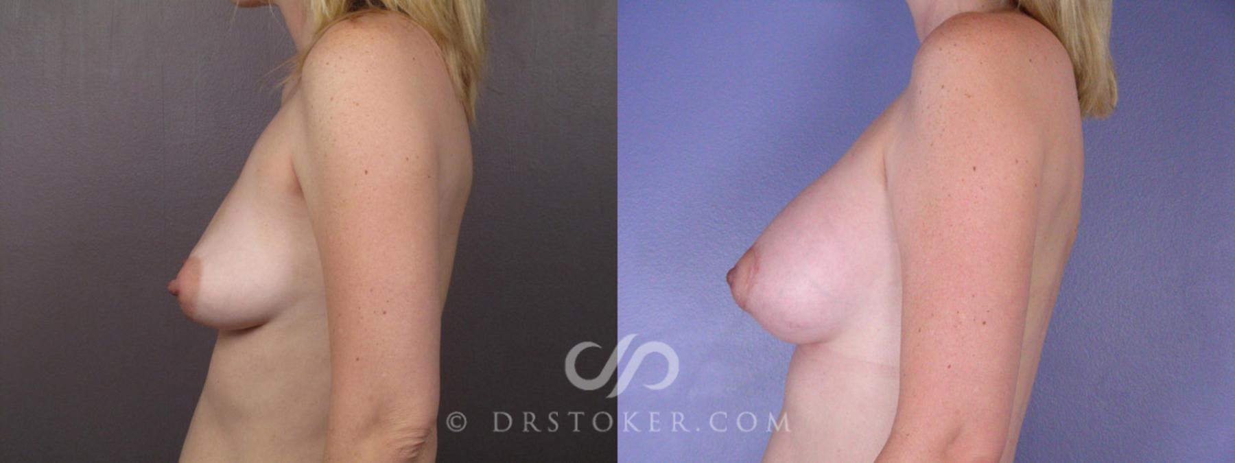 Before & After Breast Augmentation, Rapid Recovery Case 194 View #5 View in Los Angeles, CA