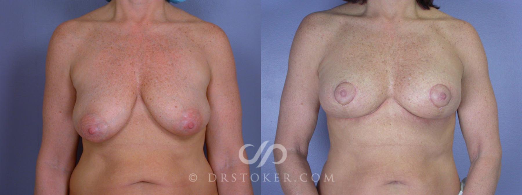 Before & After Breast Lift Case 195 View #1 View in Los Angeles, CA