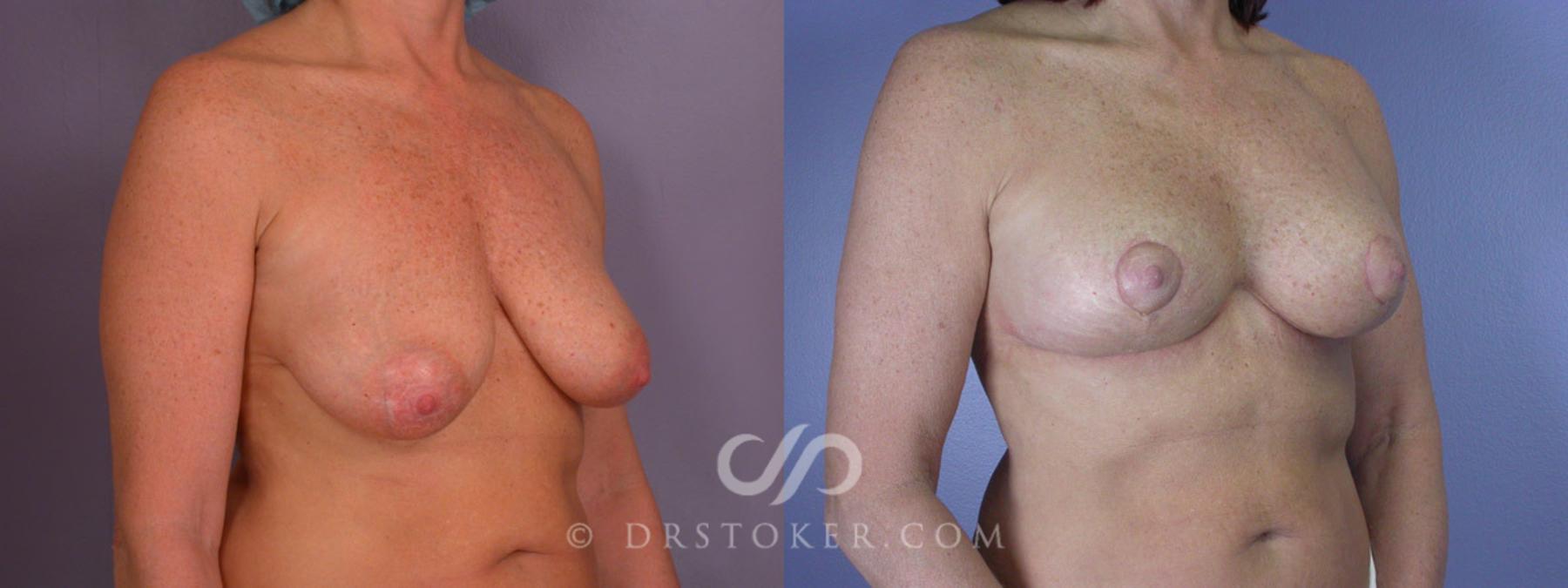 Before & After Breast Lift Case 195 View #2 View in Los Angeles, CA