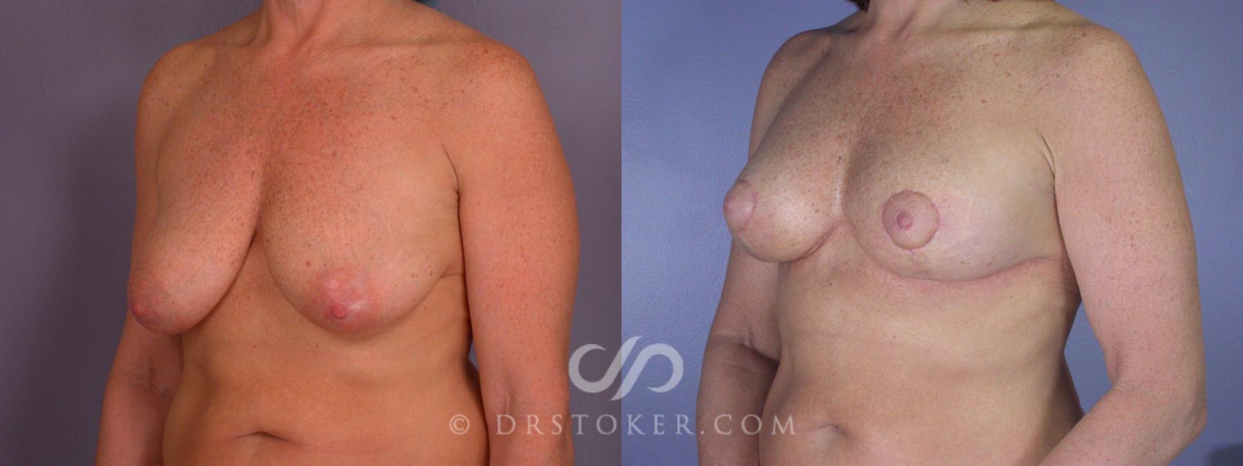 Before & After Breast Lift Case 195 View #3 View in Los Angeles, CA