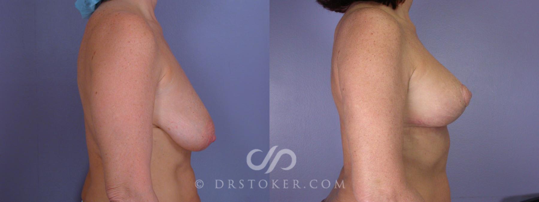 Before & After Breast Lift Case 195 View #4 View in Los Angeles, CA