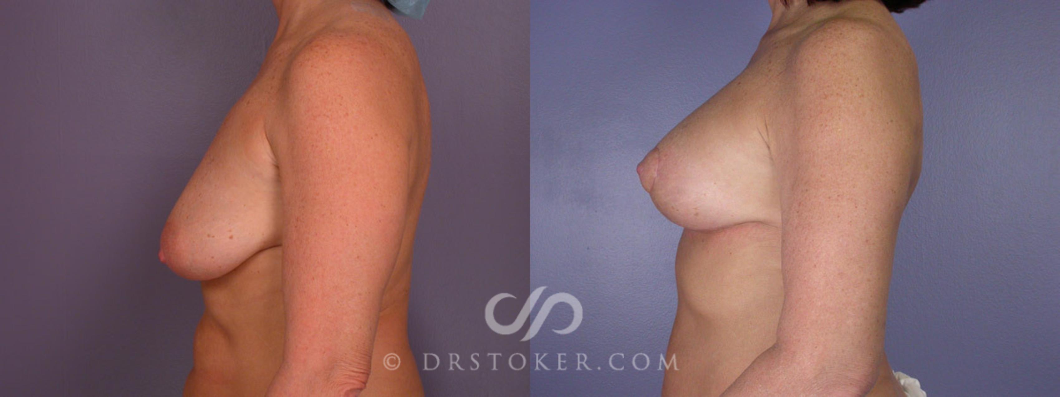 Before & After Breast Lift Case 195 View #5 View in Los Angeles, CA