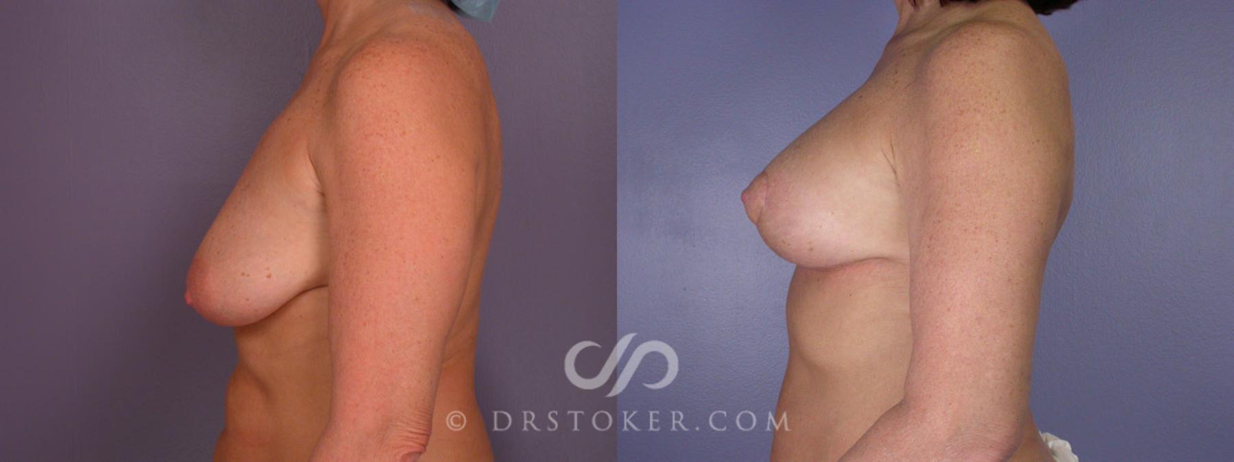 Before & After Breast Lift Case 195 View #5 View in Los Angeles, CA