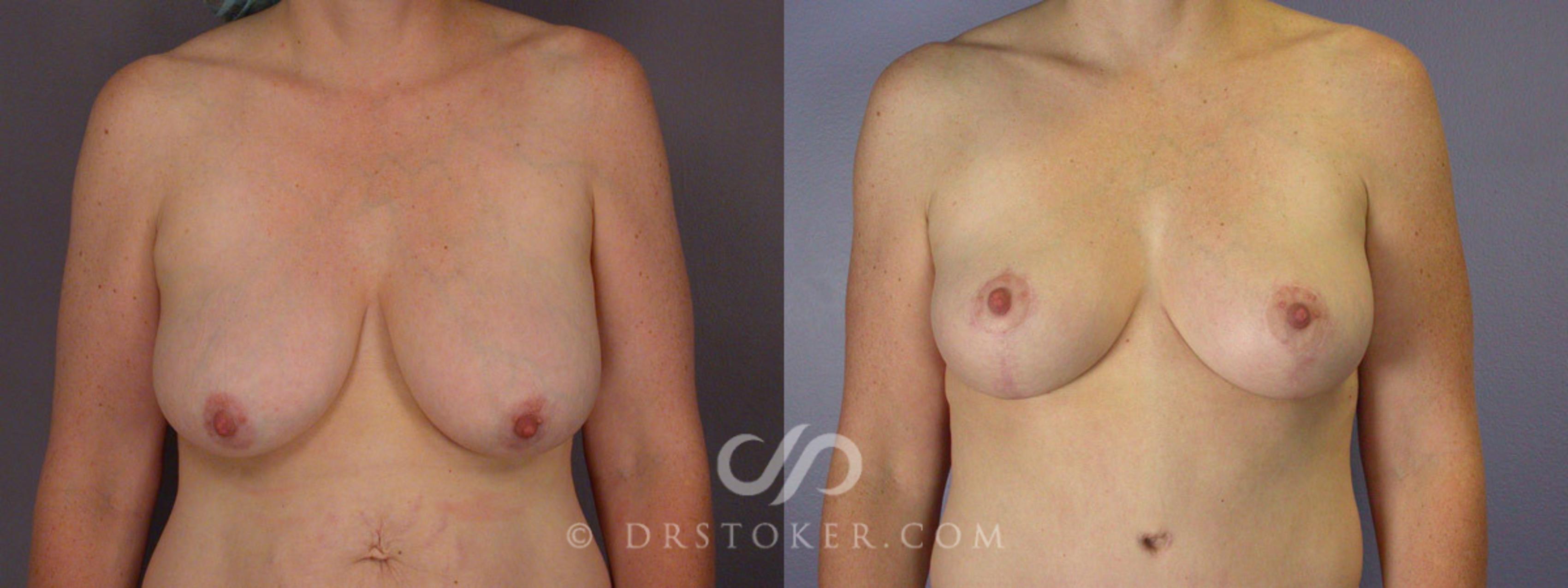 Before & After Breast Lift Case 196 View #1 View in Los Angeles, CA