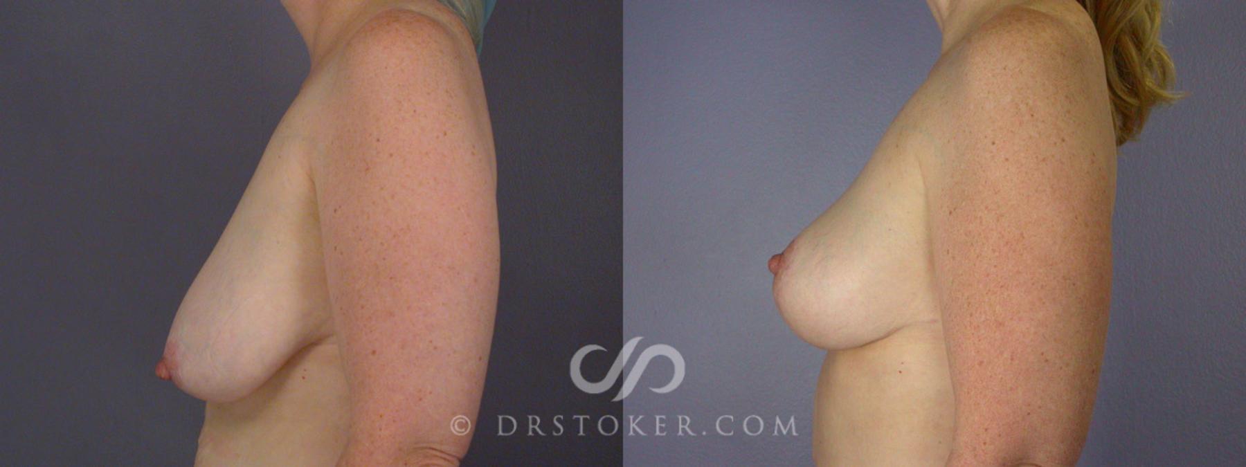 Before & After Breast Lift Case 196 View #2 View in Los Angeles, CA