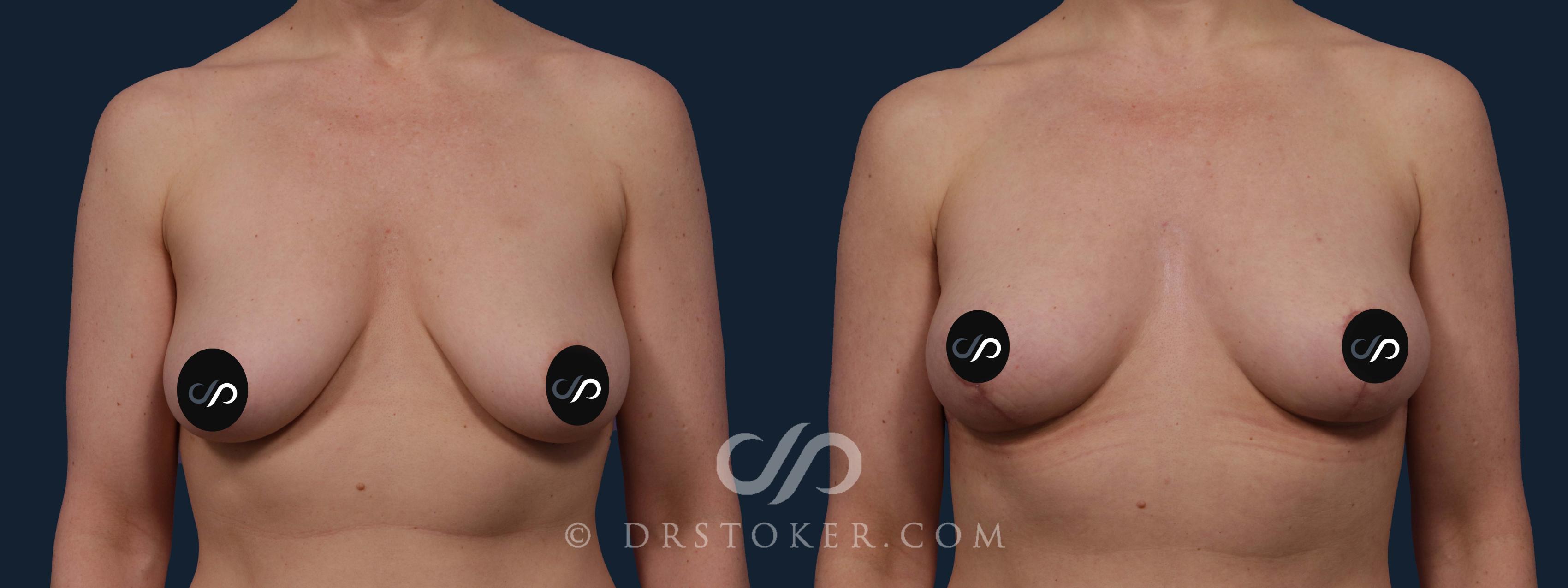 Before & After Breast Lift Case 1969 Front View in Los Angeles, CA