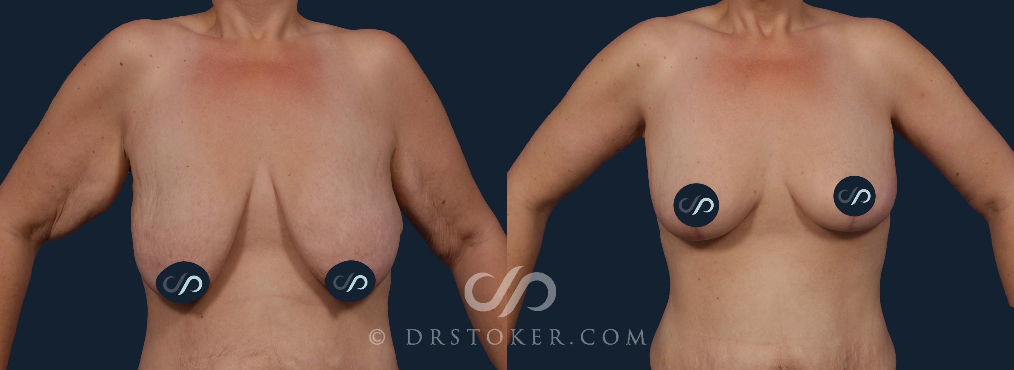 Before & After Breast Lift Case 1971 Front View in Los Angeles, CA