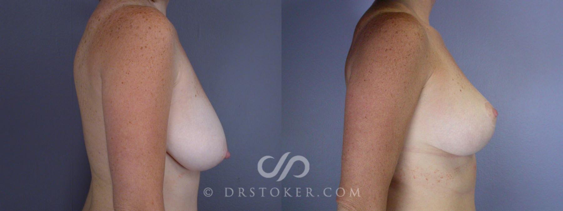Before & After Breast Lift Case 198 View #2 View in Los Angeles, CA