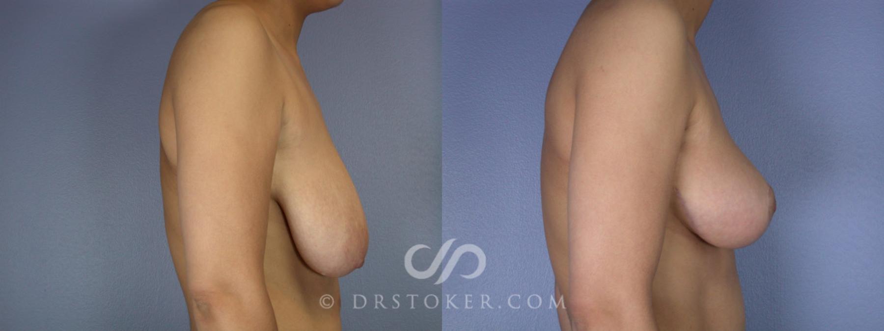 Before & After Breast Lift Case 199 View #2 View in Los Angeles, CA