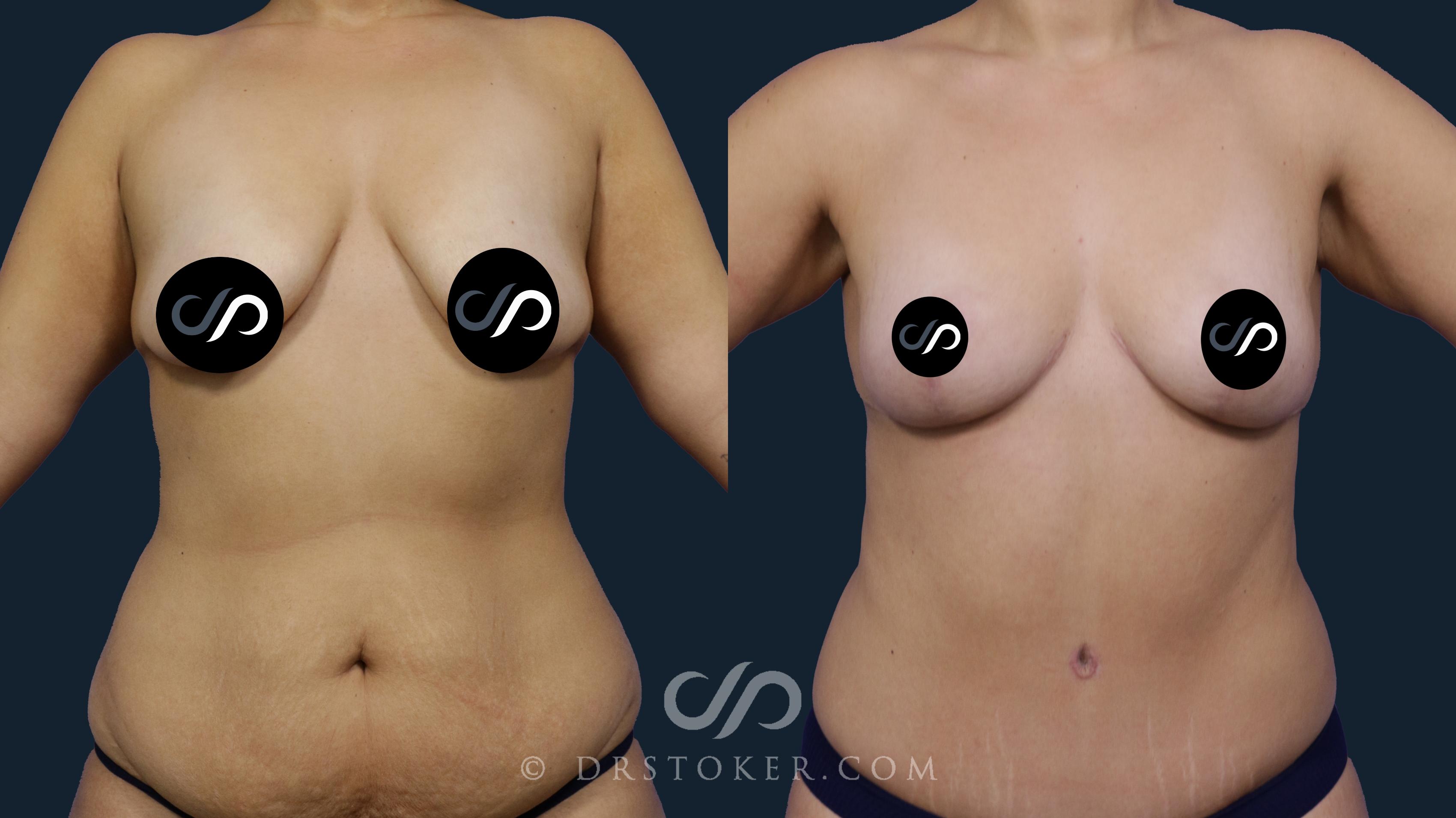 Before & After Breast Lift Case 1990 Front View in Los Angeles, CA