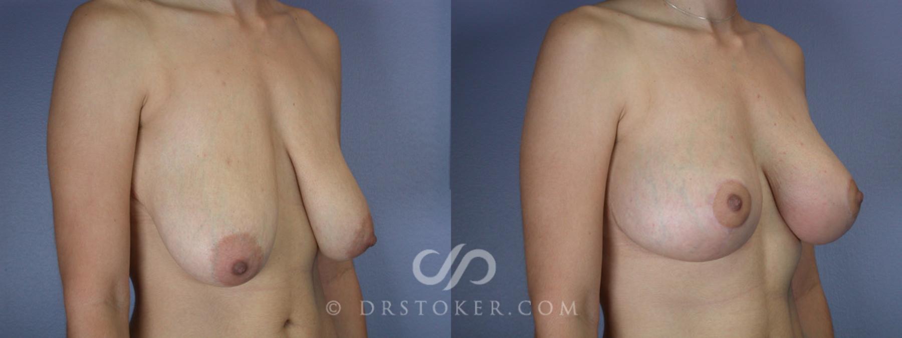 Before & After Breast Lift Case 200 View #2 View in Los Angeles, CA