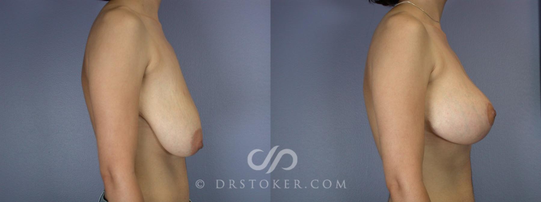 Before & After Breast Lift Case 200 View #3 View in Los Angeles, CA