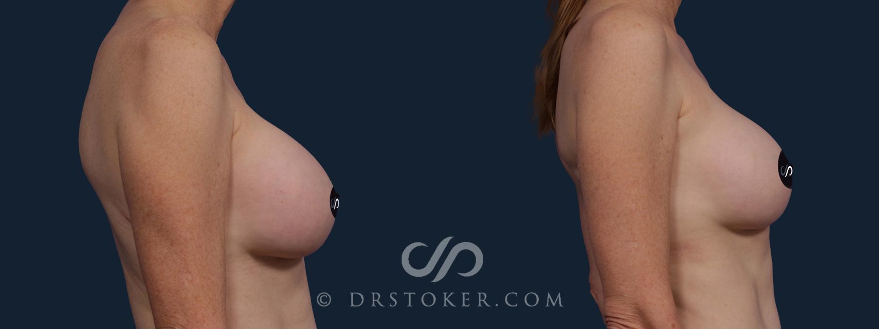 Before & After Breast Lift Case 2005 Right Side View in Los Angeles, CA