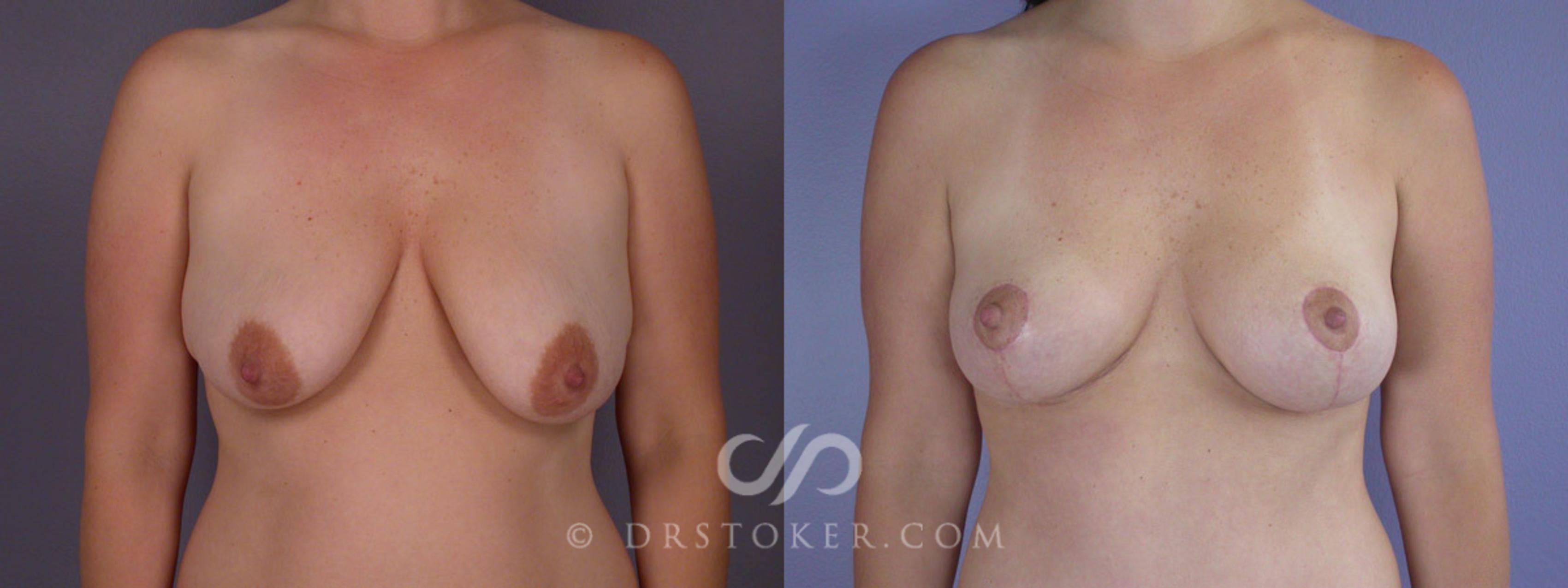 Before & After Breast Lift Case 201 View #1 View in Marina del Rey, CA