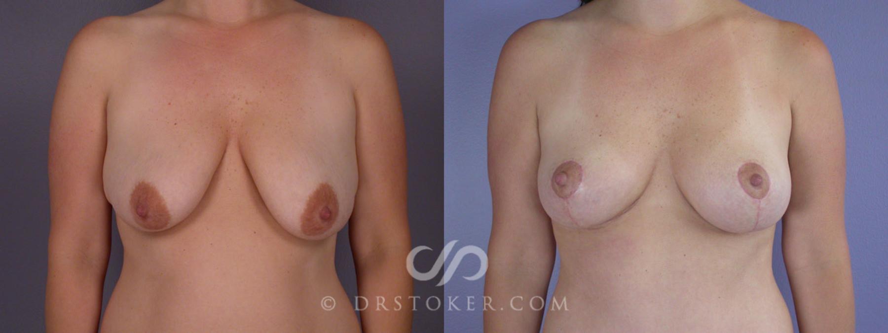 Before & After Breast Lift Case 201 View #1 View in Los Angeles, CA