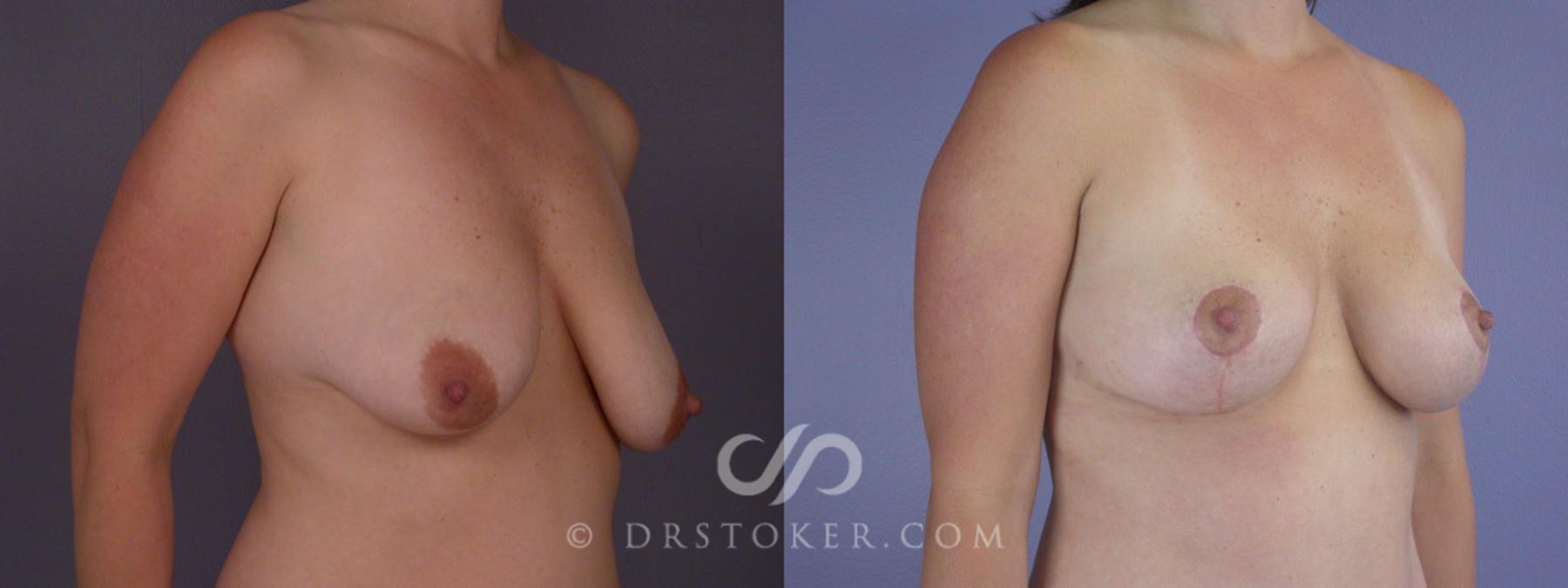 Before & After Breast Lift Case 201 View #2 View in Los Angeles, CA
