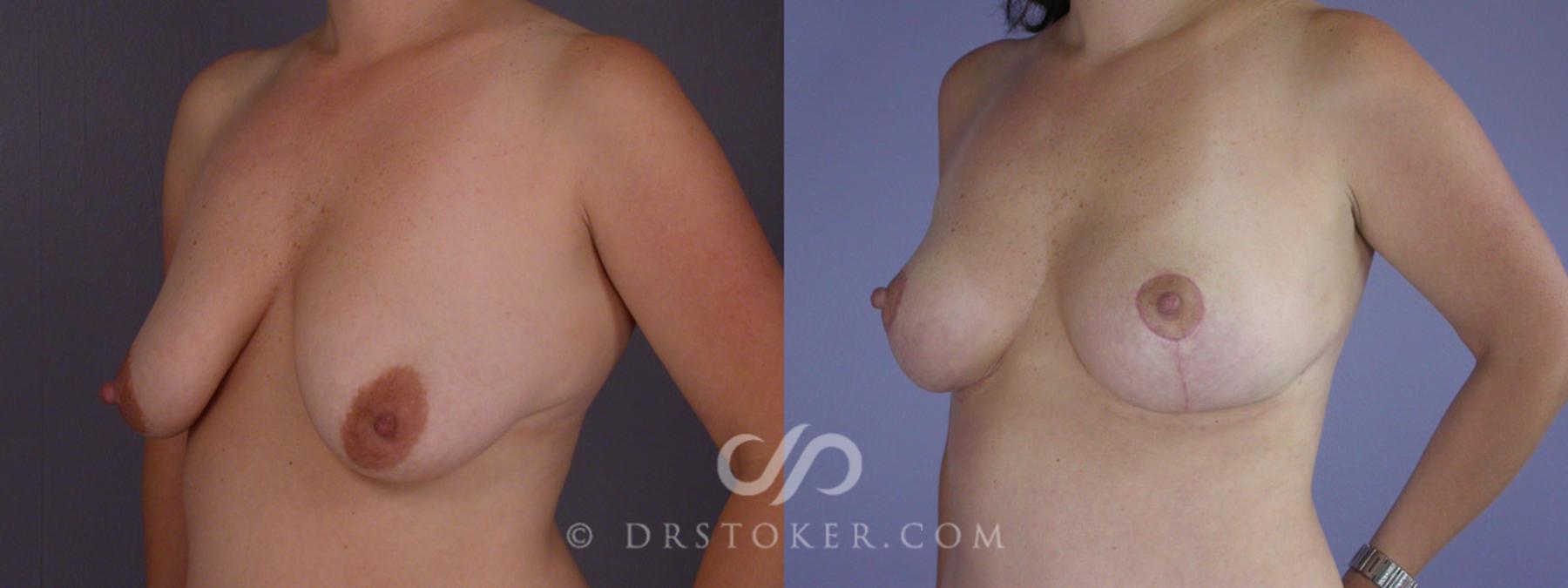 Before & After Breast Lift Case 201 View #3 View in Los Angeles, CA