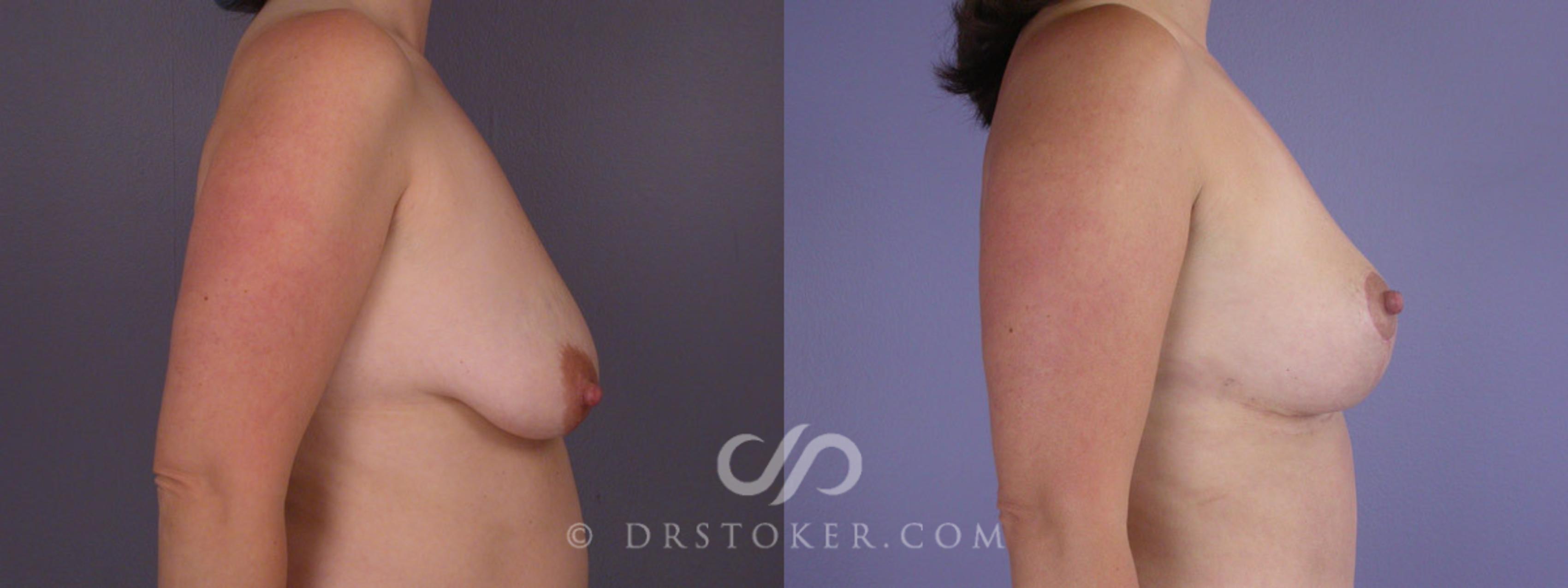 Before & After Breast Lift Case 201 View #4 View in Los Angeles, CA