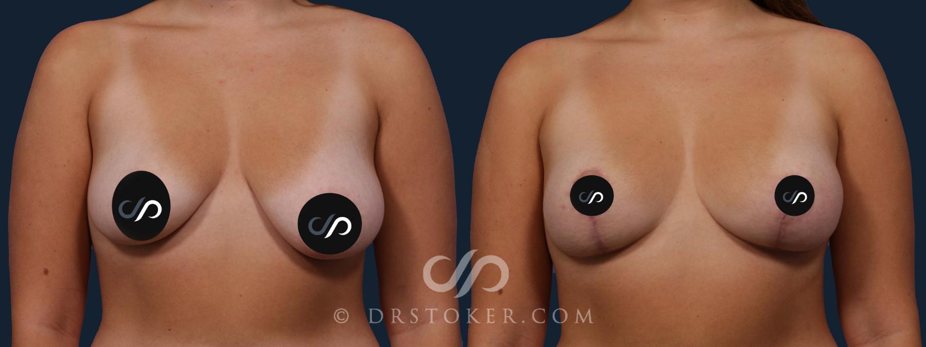 Before & After Breast Lift Case 2016 Front View in Los Angeles, CA