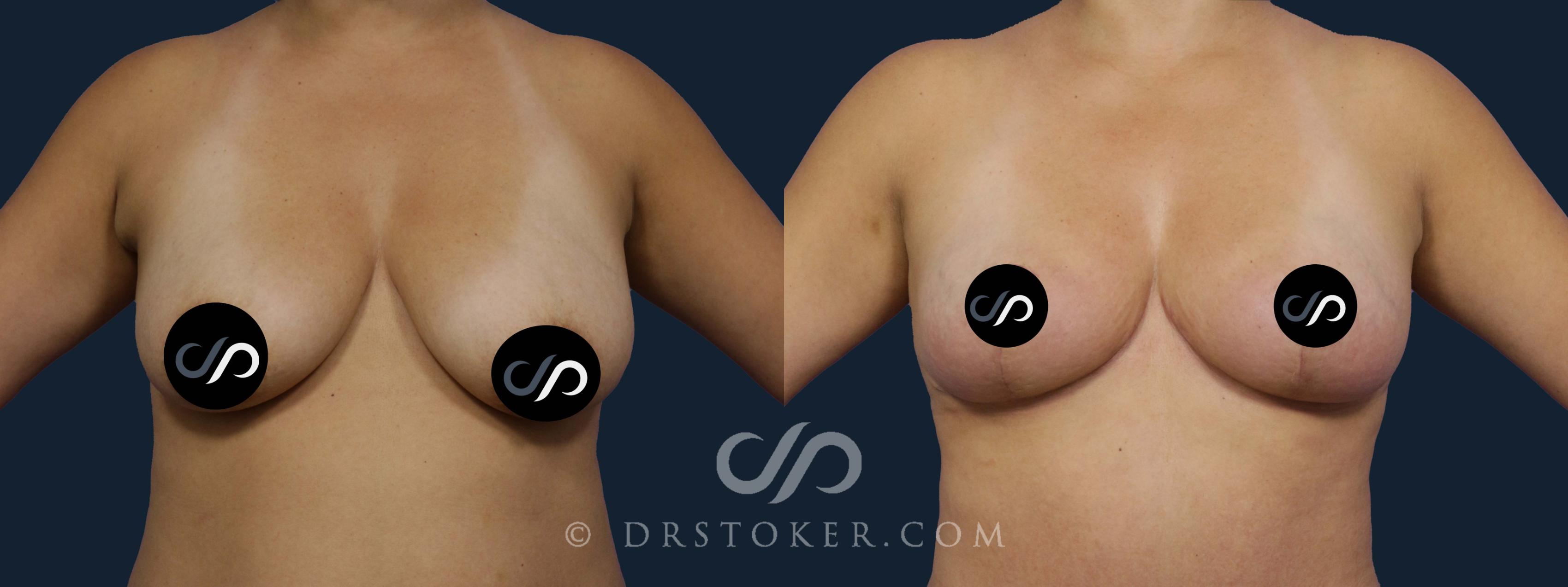 Before & After Breast Lift Case 2054 Front View in Los Angeles, CA