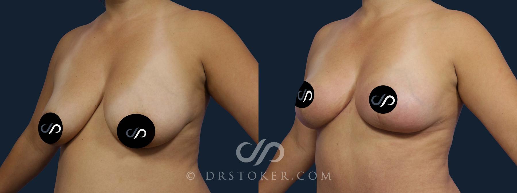 Before & After Breast Lift Case 2054 Left Oblique View in Los Angeles, CA
