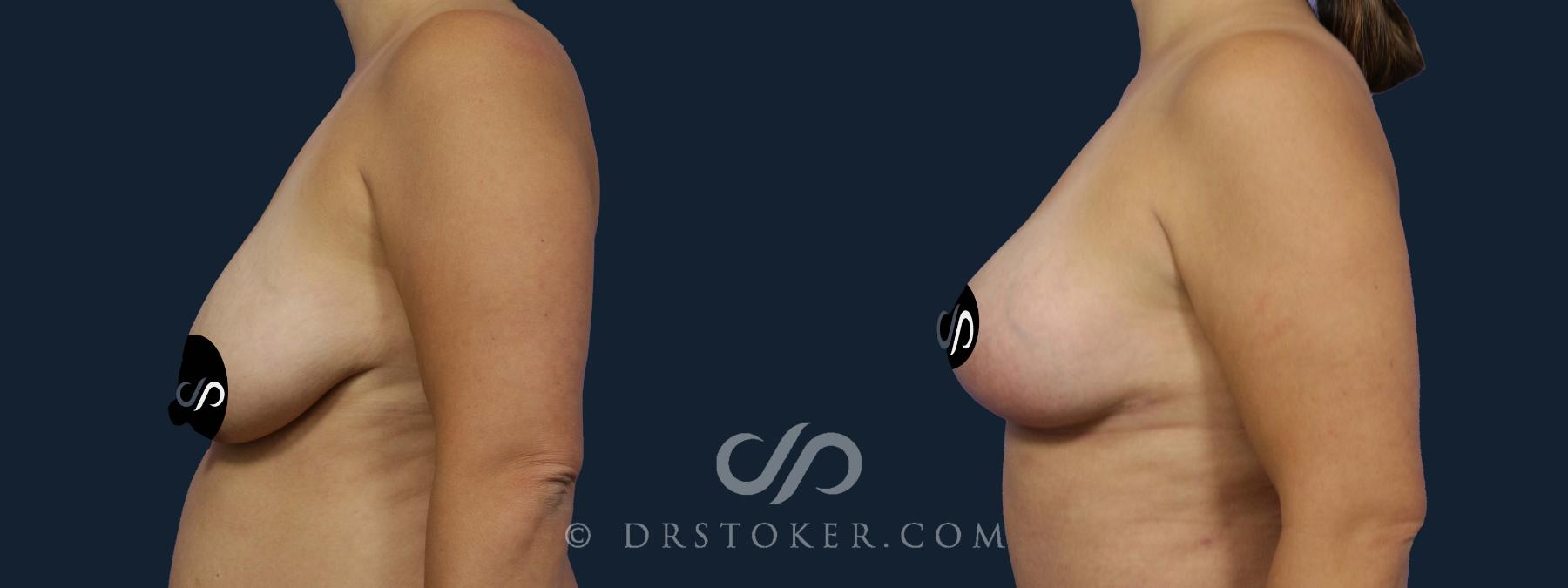 Before & After Breast Lift Case 2054 Left Side View in Los Angeles, CA