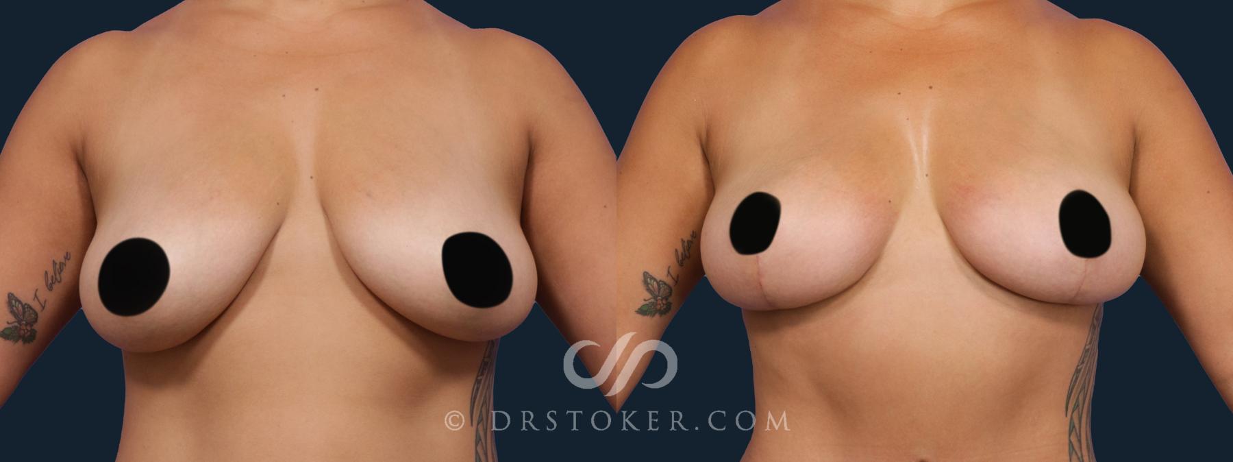 Before & After Breast Lift Case 2090 Front View in Los Angeles, CA