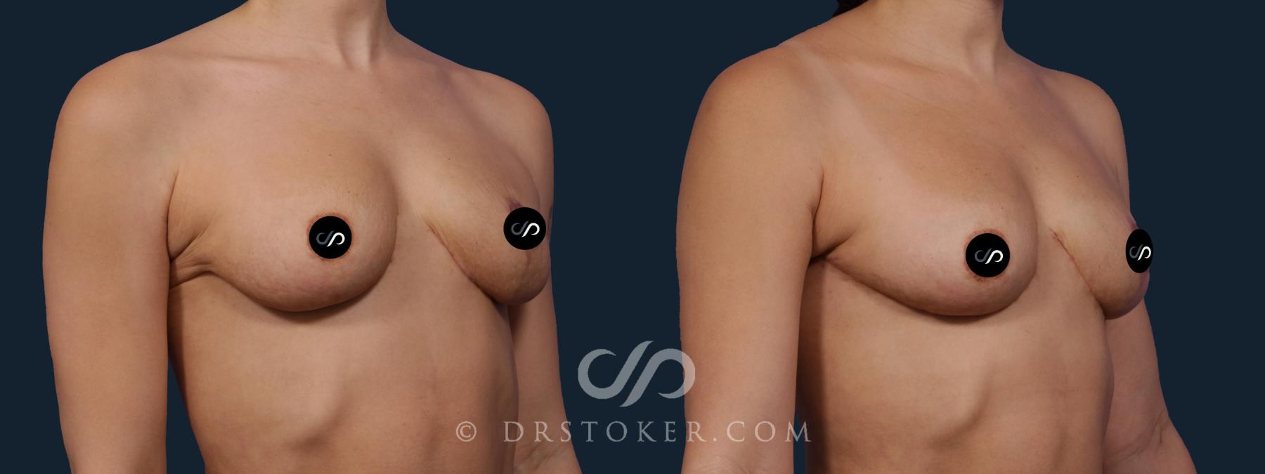 Before & After Breast Lift Case 2148 Right Oblique View in Los Angeles, CA