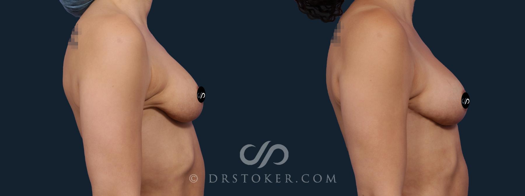Before & After Breast Lift Case 2148 Right Side View in Los Angeles, CA