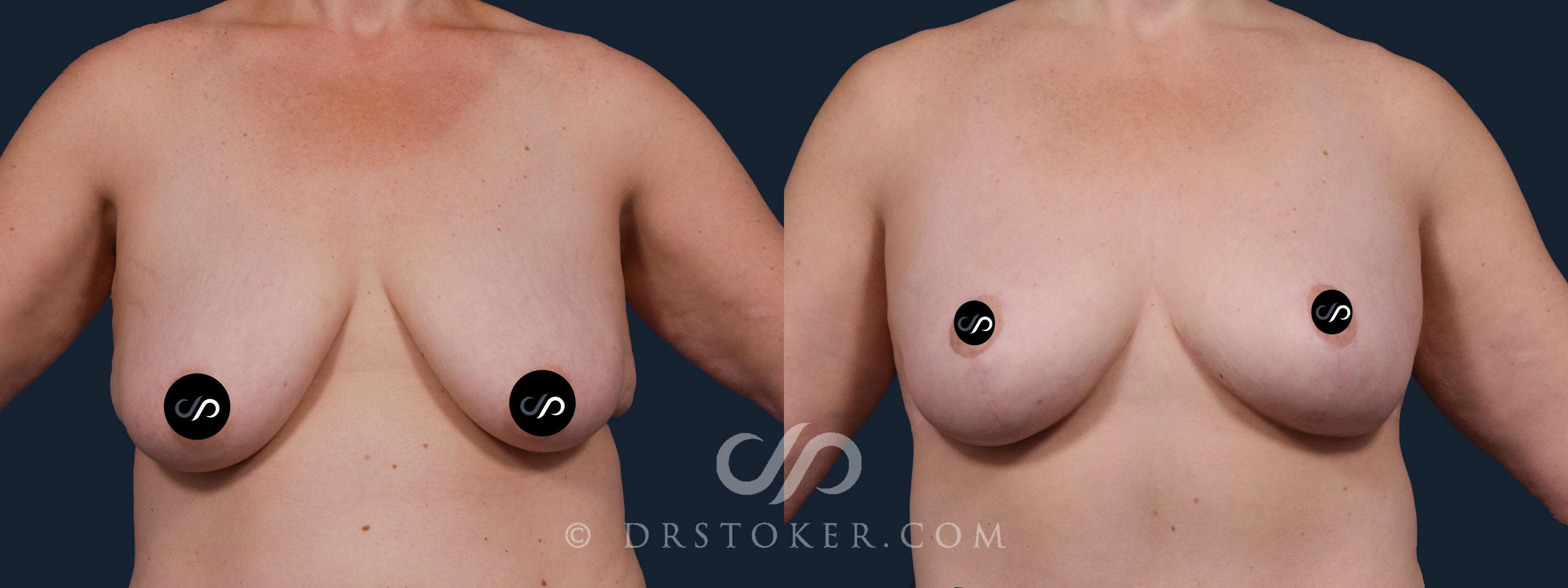 Before & After Breast Lift Case 2151 Front View in Los Angeles, CA