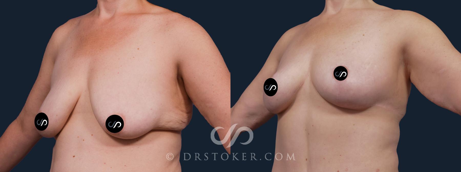 Before & After Breast Lift Case 2151 Left Oblique View in Los Angeles, CA