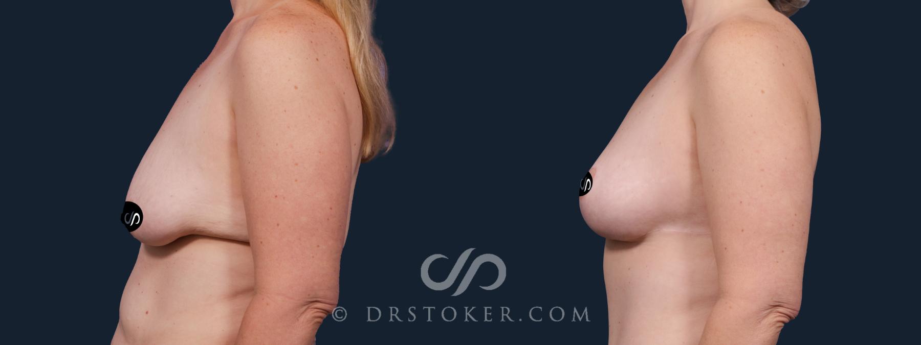 Before & After Breast Lift Case 2151 Left Side View in Los Angeles, CA