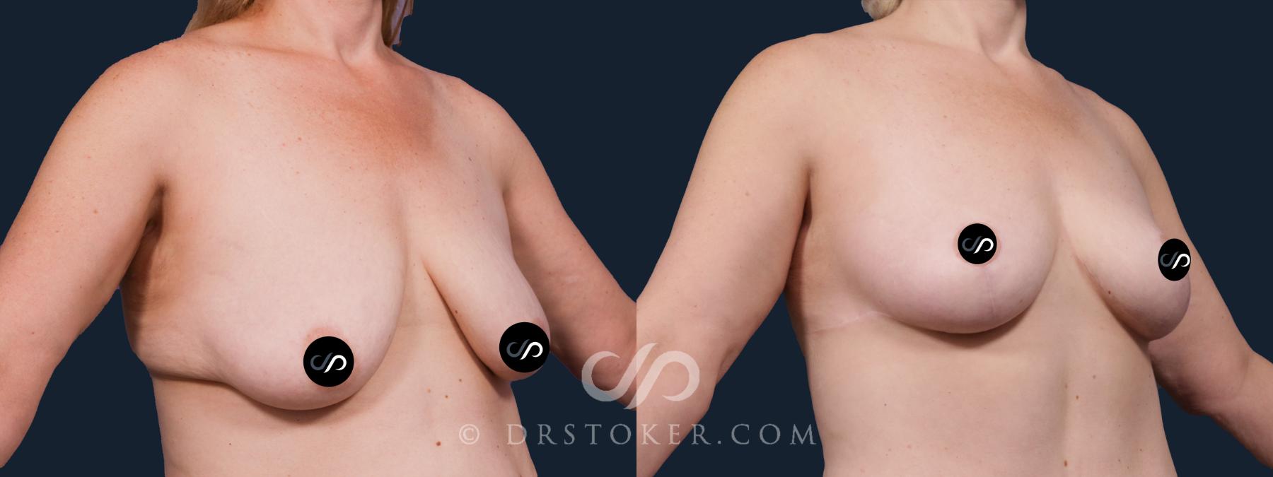 Before & After Breast Lift Case 2151 Right Oblique View in Los Angeles, CA