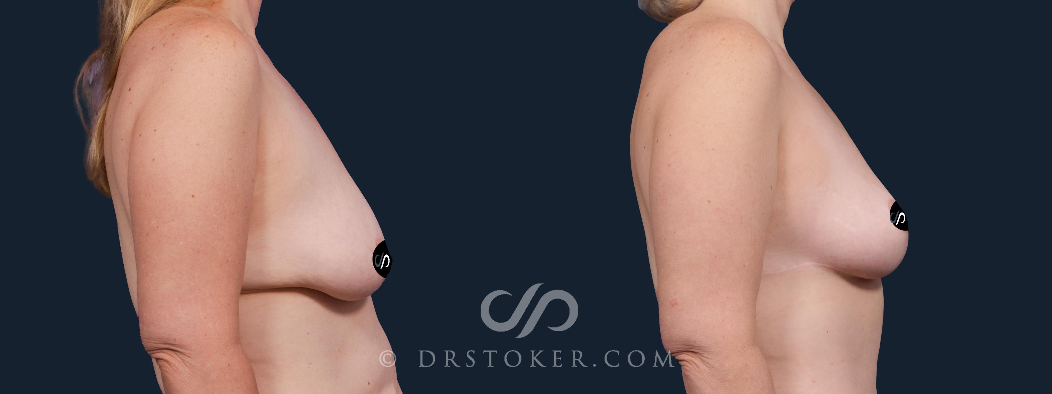 Before & After Breast Lift Case 2151 Right Side View in Los Angeles, CA