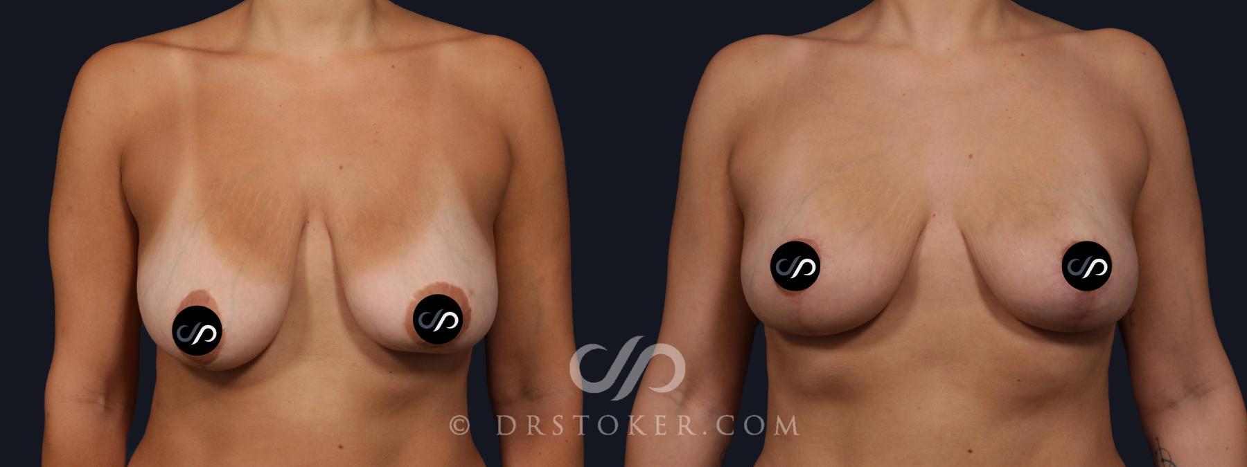 Before & After Breast Lift Case 2156 Front View in Los Angeles, CA