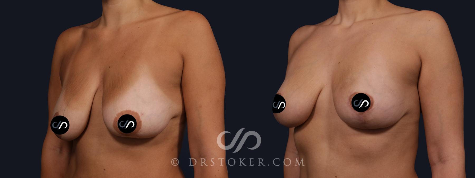Before & After Breast Lift Case 2156 Left Oblique View in Los Angeles, CA