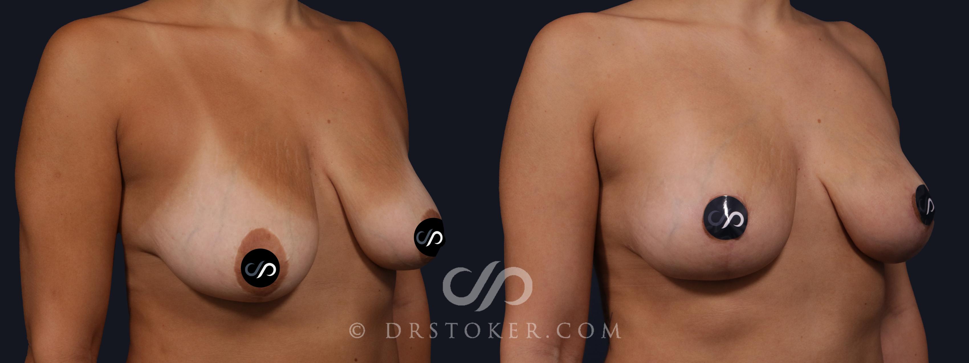 Before & After Breast Lift Case 2156 Right Oblique View in Los Angeles, CA