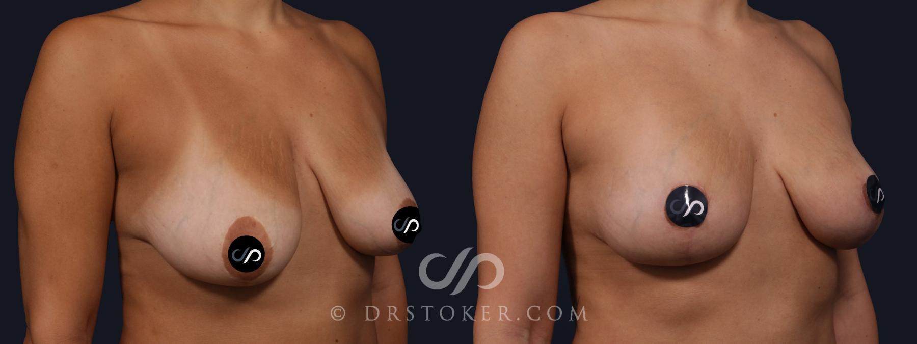 Before & After Breast Lift Case 2156 Right Oblique View in Los Angeles, CA