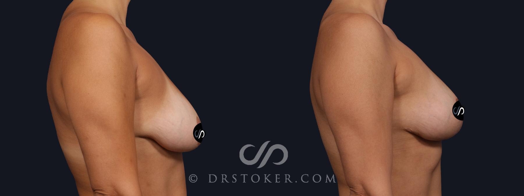 Before & After Breast Lift Case 2156 Right Side View in Los Angeles, CA
