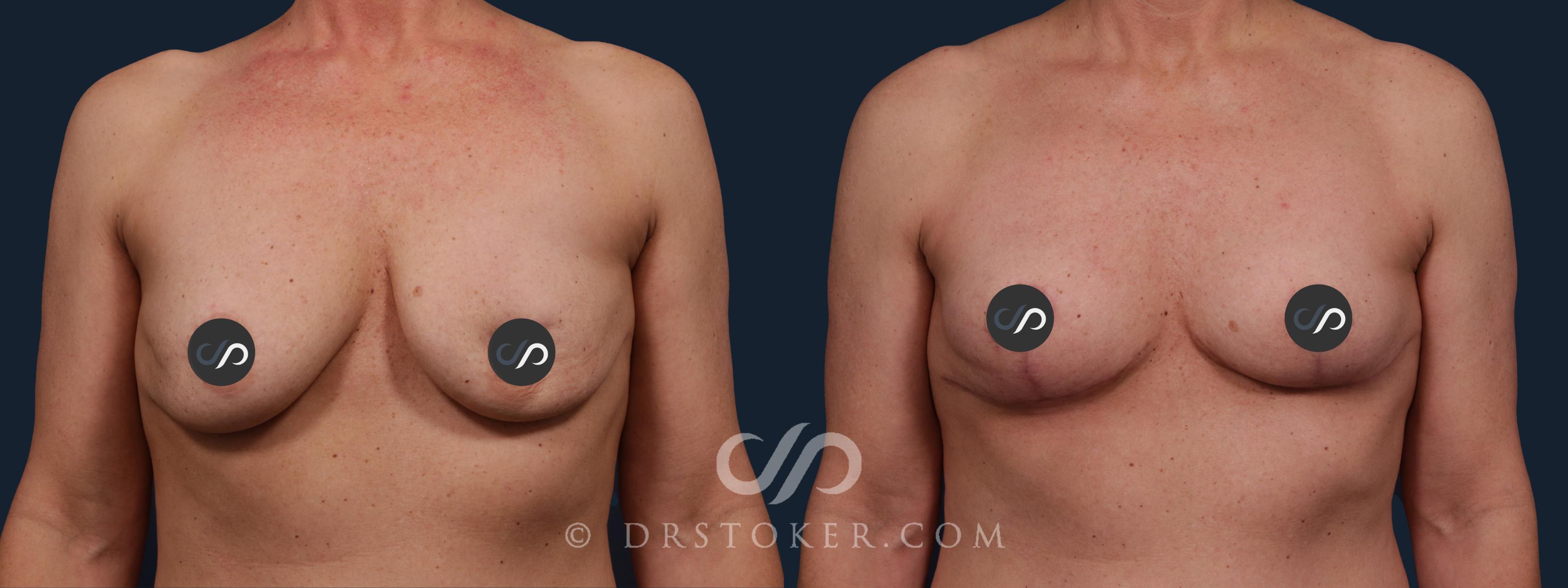 Before & After Breast Implant Removal Case 2161 Front View in Los Angeles, CA