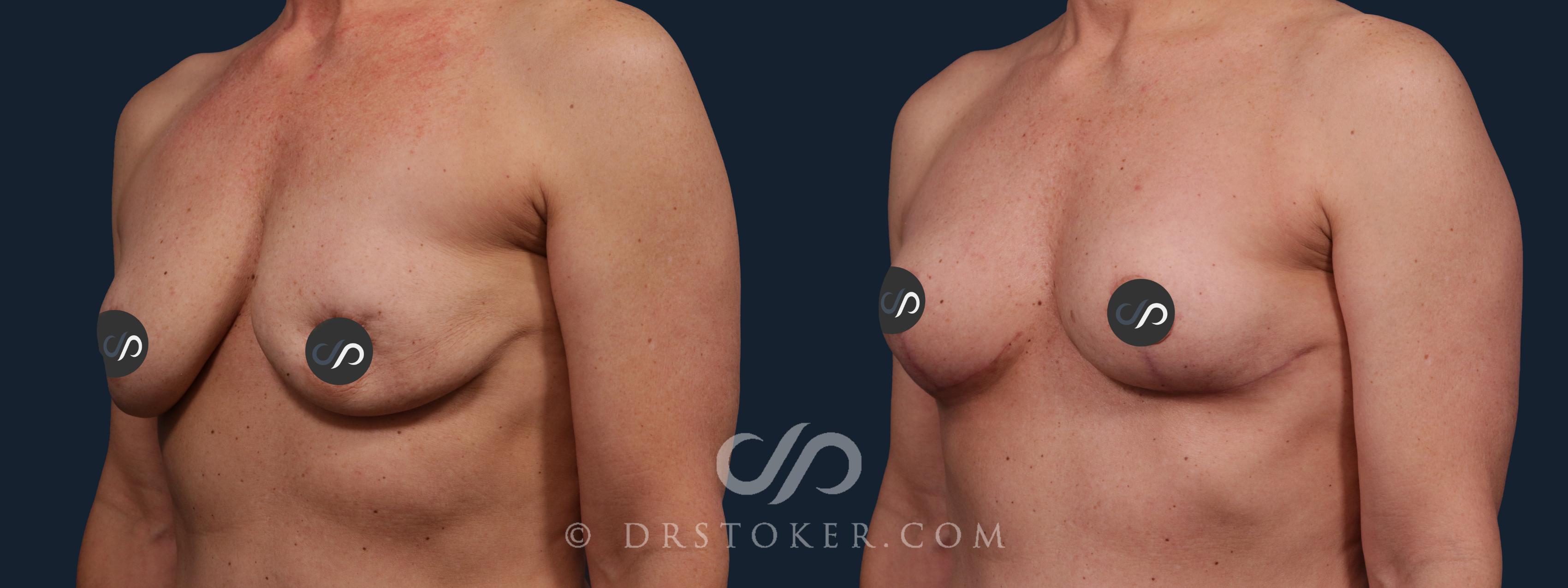 Before & After Breast Lift Case 2161 Left Oblique View in Los Angeles, CA