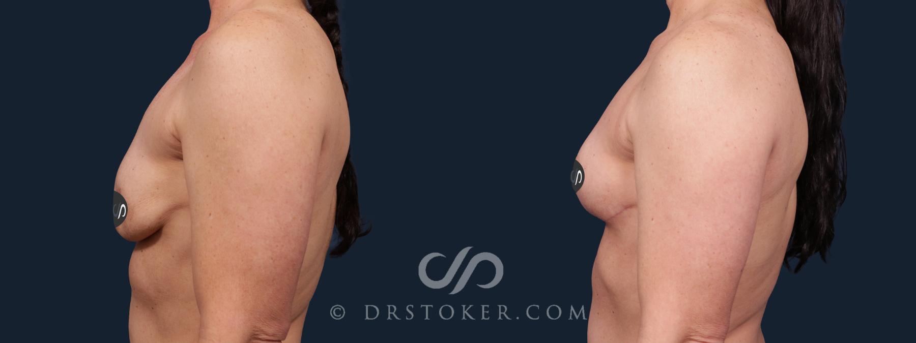 Before & After Breast Implant Removal Case 2161 Left Side View in Los Angeles, CA