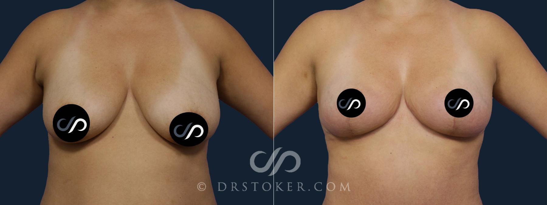 Before & After Breast Lift Case 2164 Front View in Los Angeles, CA