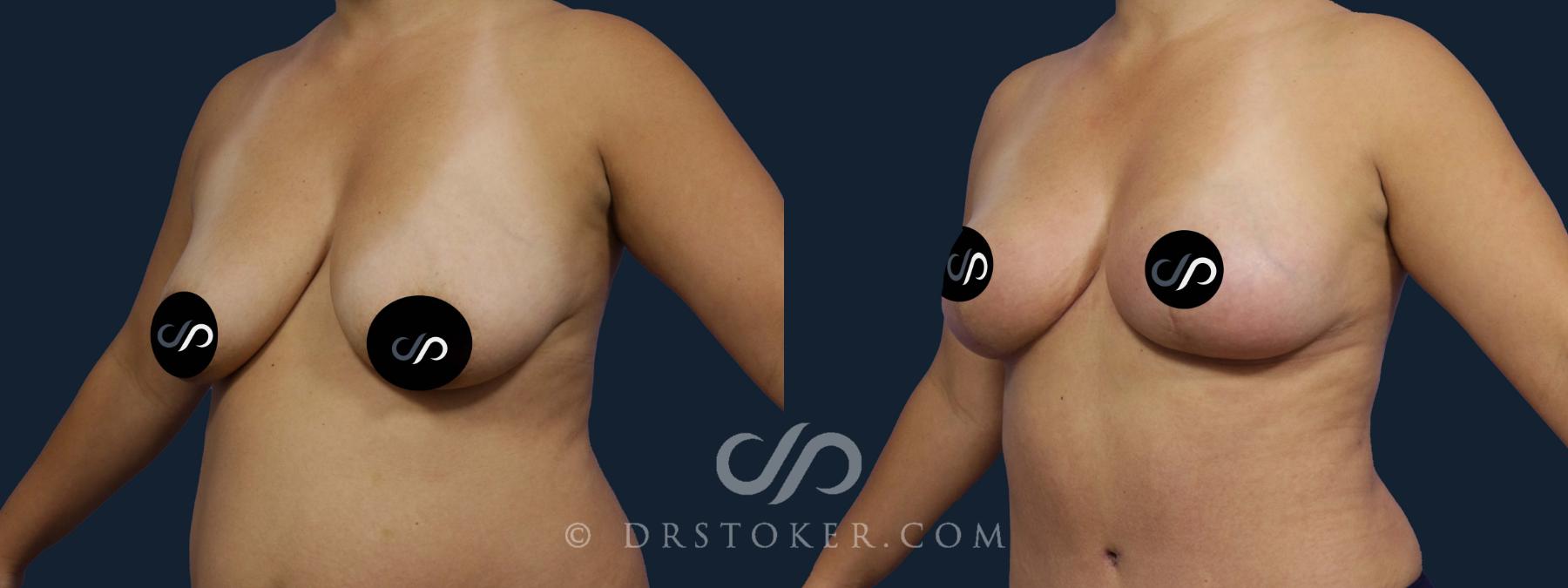 Before & After Breast Lift Case 2164 Left Oblique View in Los Angeles, CA