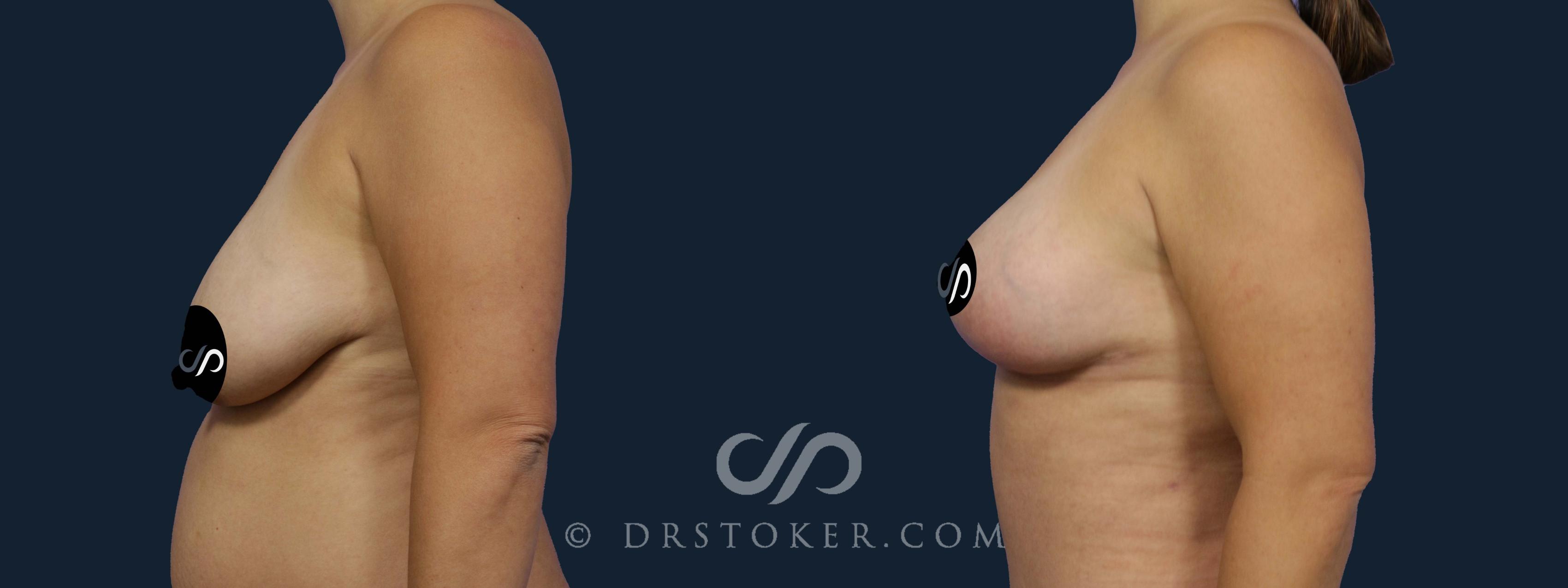 Before & After Breast Lift Case 2164 Left Side View in Los Angeles, CA