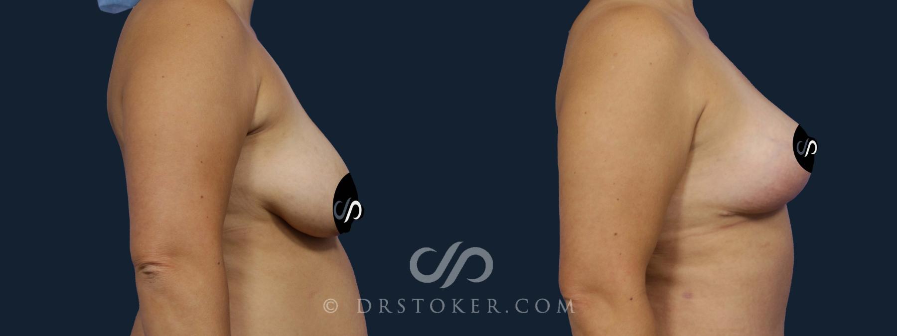 Before & After Breast Lift Case 2164 Right Side View in Los Angeles, CA
