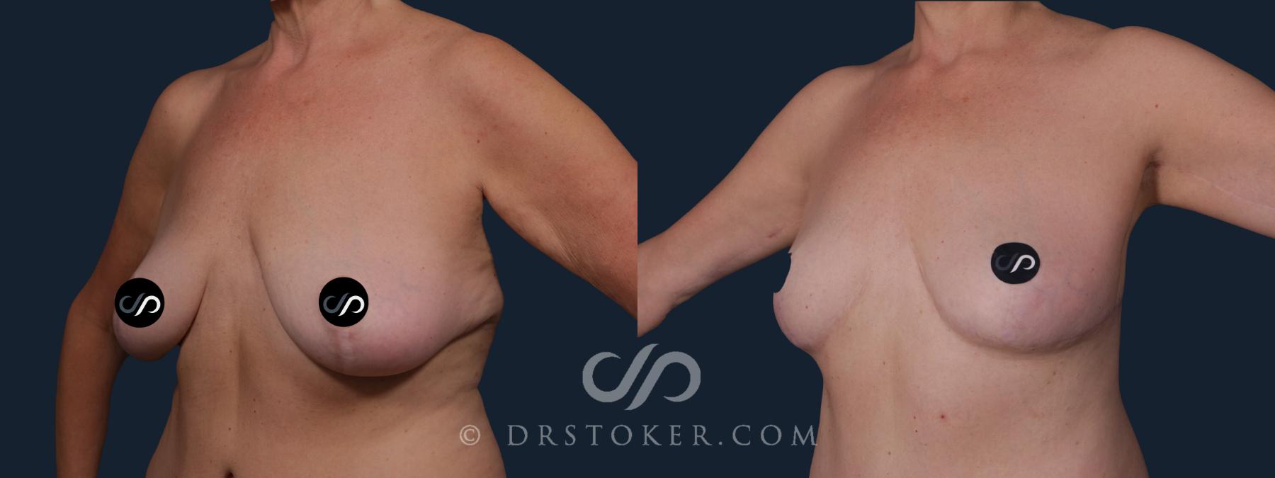 Before & After Breast Lift Case 2213 Left Oblique View in Los Angeles, CA