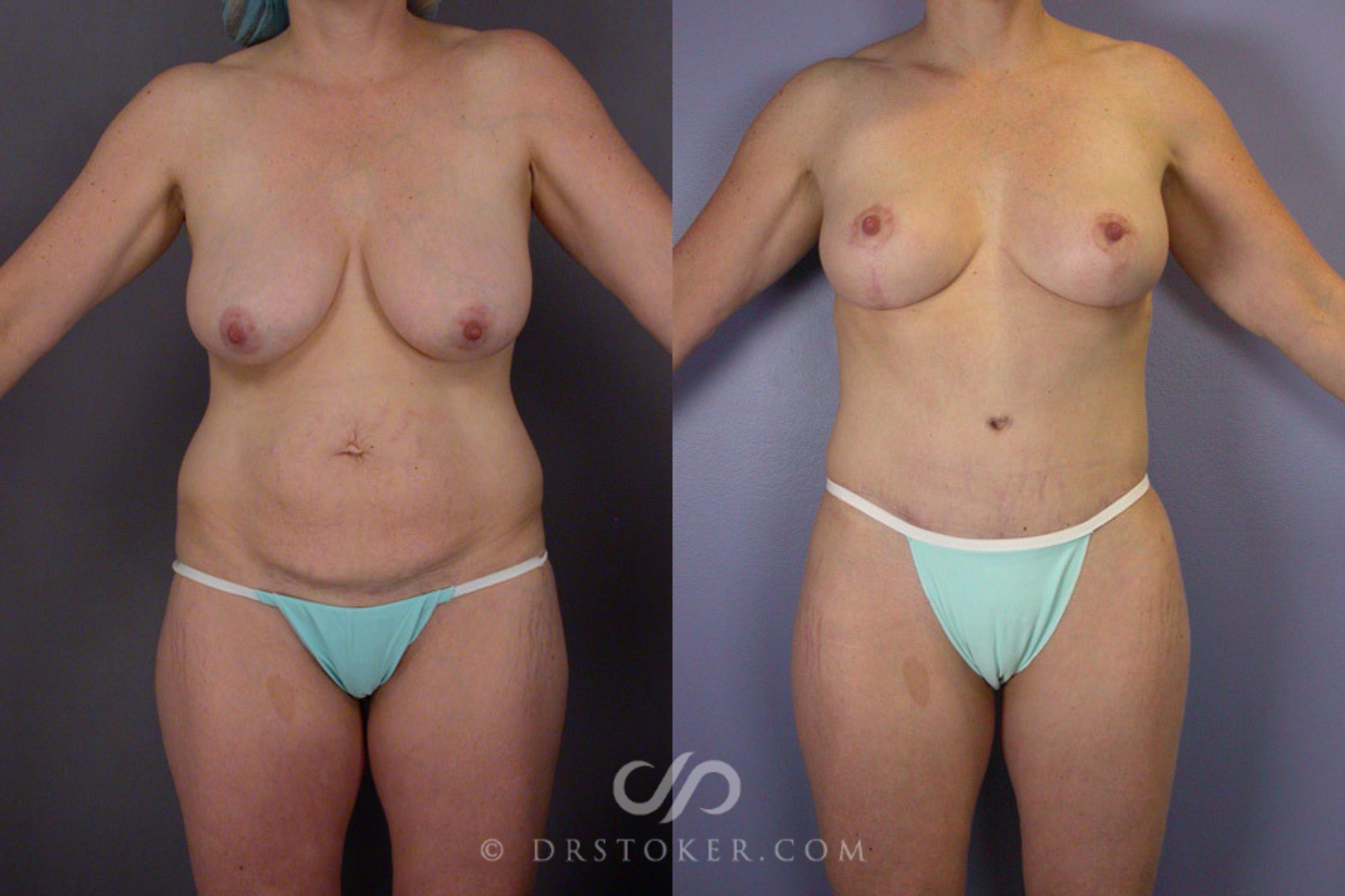 Before & After Tummy Tuck Case 240 View #1 View in Los Angeles, CA