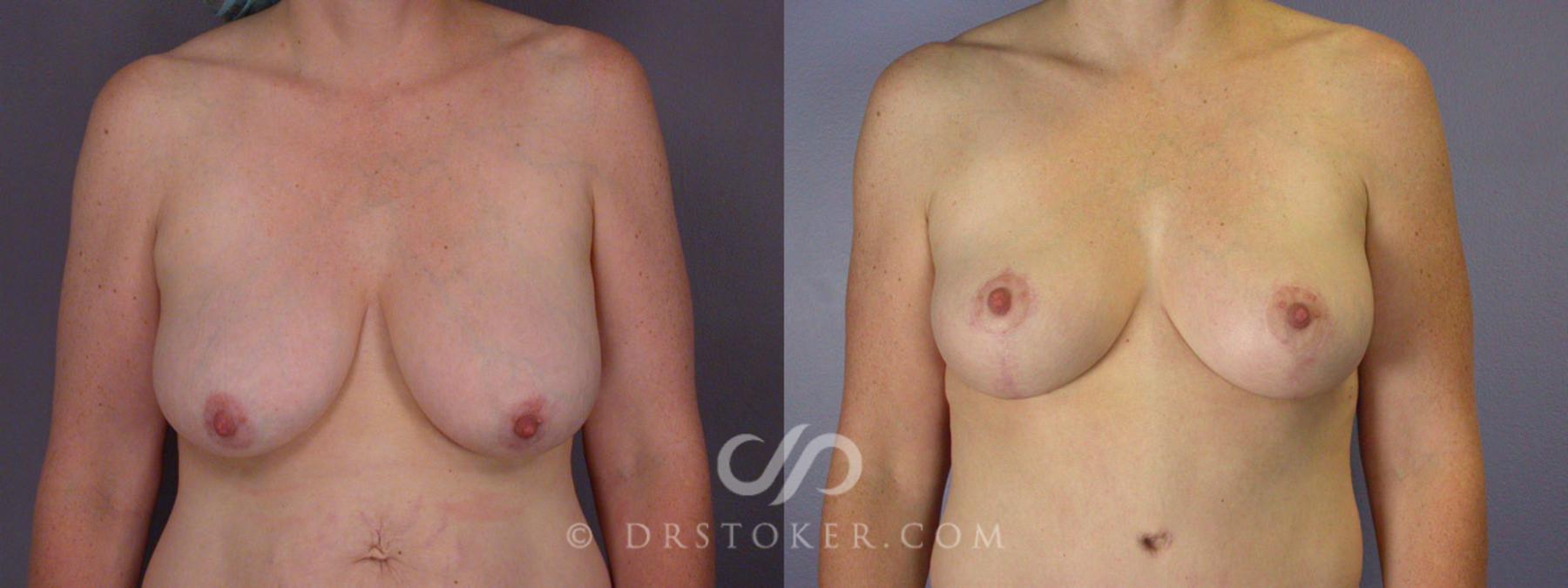 Before & After Tummy Tuck Case 240 View #10 View in Los Angeles, CA